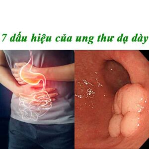 7-dấu-hiệu-của-ung-thư-dạ-dày