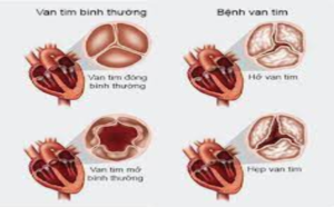 Xử lý huyết áp kẹt 