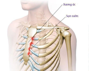 Đau tức ngực bên phải là bệnh gì