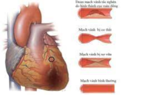 Bệnh tim do thiếu máu cục bộ