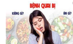 Bệnh quai bị nên kiêng gì